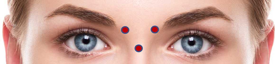 Drei Injektionspunkte bei der Behandlung der Glabellafalten mit Botulinumtoxin - effektiv, sicher und anatomisch sinnvoll?