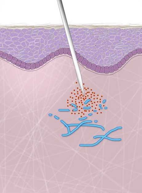 Hyaluronidase in der Ästhetischen Medizin - Neuer Behandlungsalgorithmus