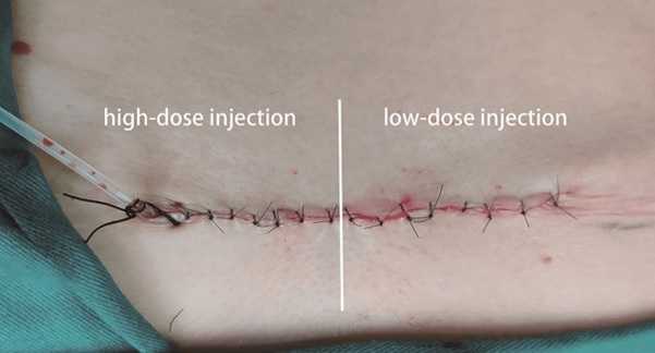 Der Einfluss der Botulinumtoxin-Injektionsdosis auf das Erscheinungsbild chirurgischer Narben