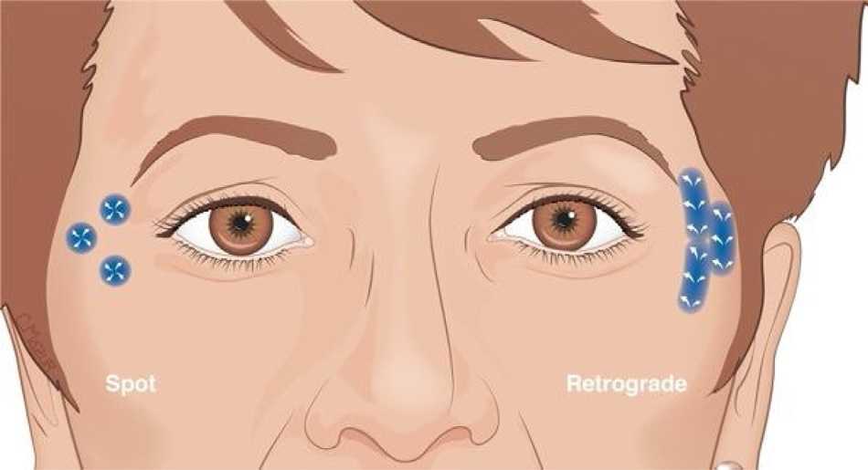 Retrograde vs Bolus-Injektion von Botulinumtoxin 
