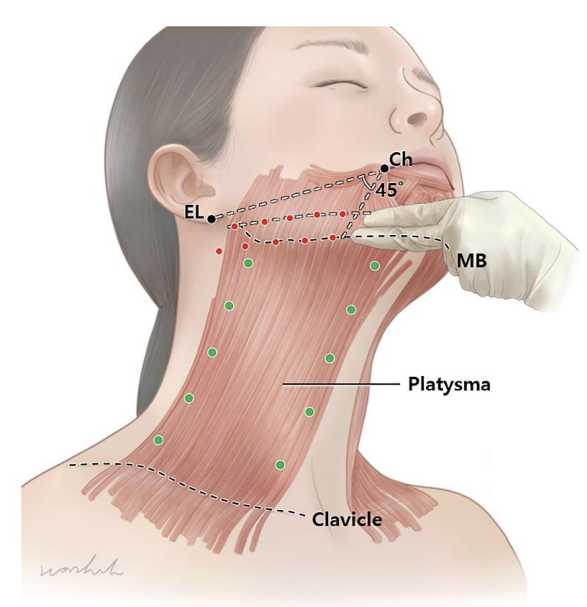 Jawline- und Platysma-Halslifting mit Botulinumtoxin 