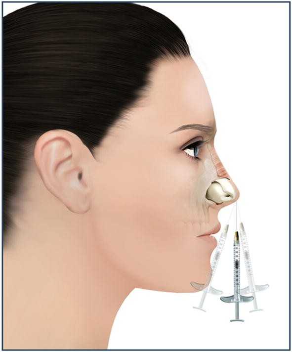 Chirurgische Rhinoplastik nach vorheriger nasaler Umgestaltung mit Hyaluronsäure