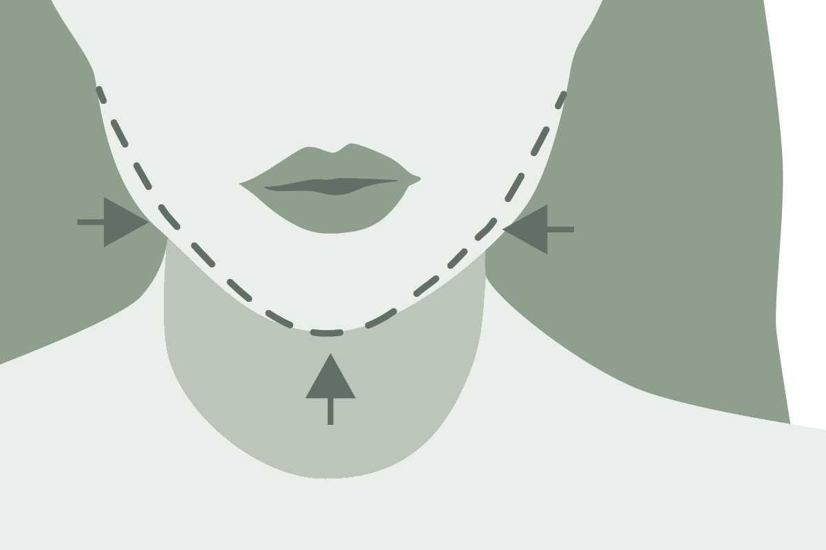 Konturierung des Untergesichts und des Massetermuskels: Eine minimal-invasive Lösung mit Botulinum für ein feminineres Gesicht